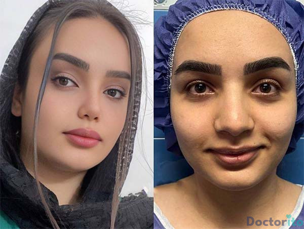 عکس عمل بینی گوشتی نیمه فانتزی
