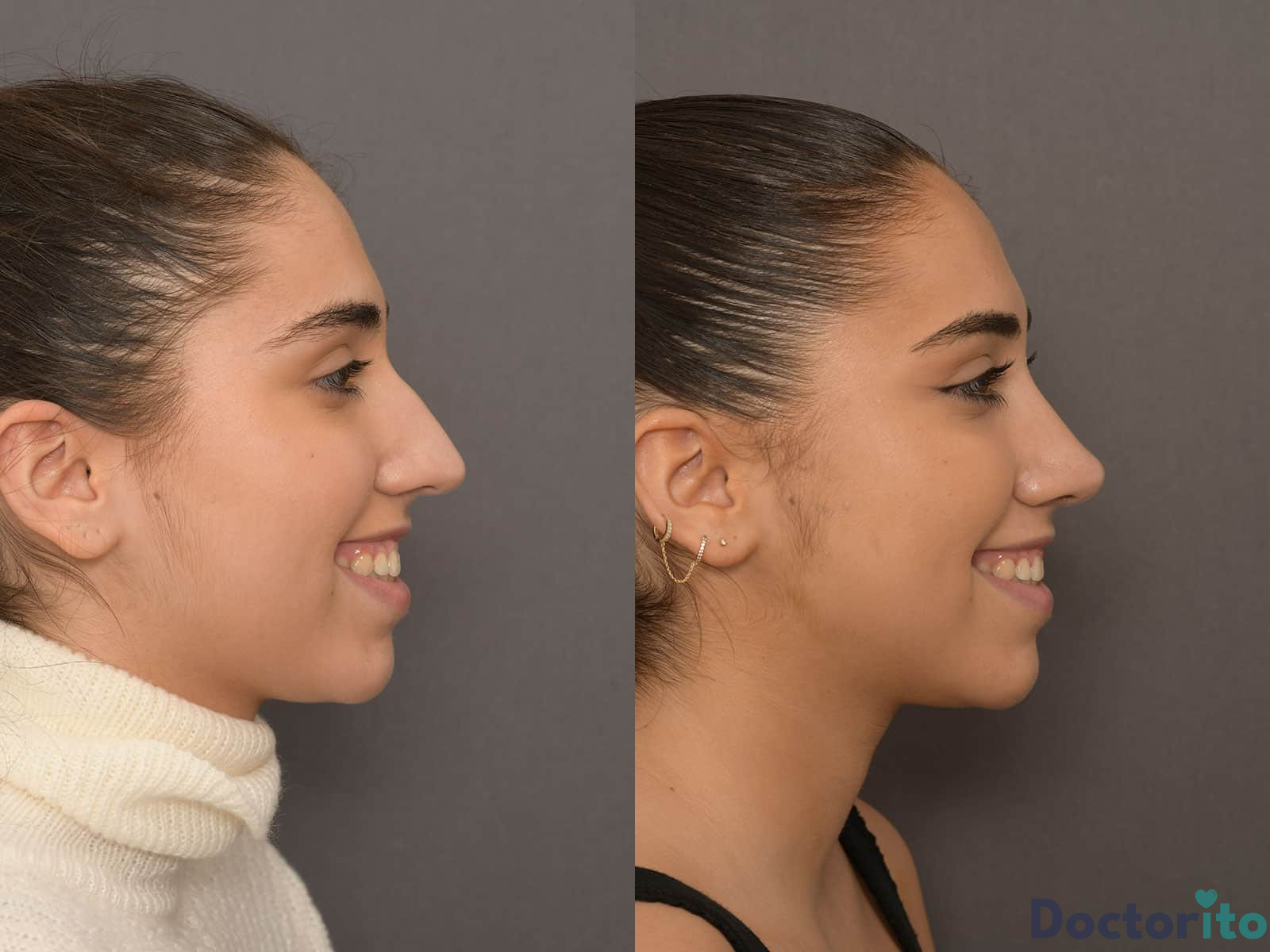 eliana samonas before after
