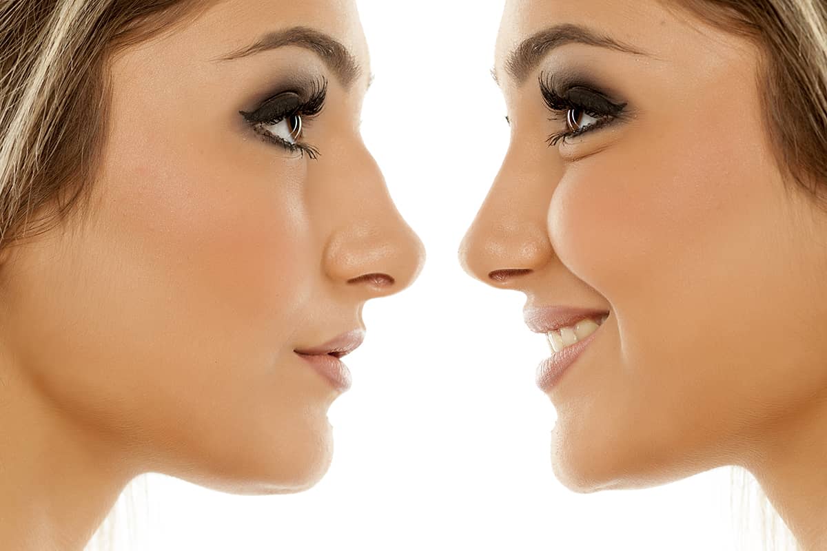 مراقبت‌های پس از جراحی بینی برای اصلاح نوک بینی عریض