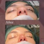 نمونه کار جراحی بینی دکتر بهروز گندمی (3)