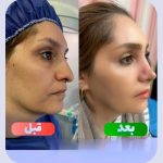 نمونه عمل بینی دکتر وحید عین آبادی 2
