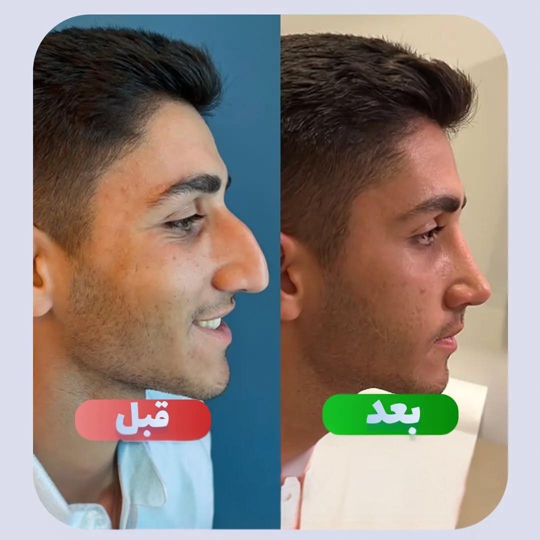 نمونه عمل بینی دکتر وحید عین آبادی 1