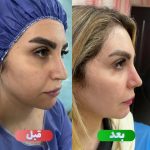 نمونه عمل بینی دکتر وحید عین آبادی 3