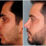 نمونه جراحی بینی دکتر بهنام خرمی (2)