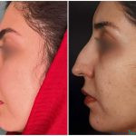 نمونه جراحی بینی دکتر بهنام خرمی (6)
