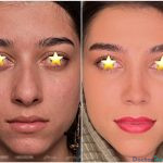 نمونه جراحی بینی دکتر بهنام خرمی (8)