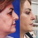 نمونه جراحی بینی دکتر حنیف اخوت (2)