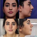 نمونه جراحی بینی دکتر حنیف اخوت (8)