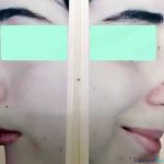نمونه جراحی بینی دکتر سلیمان زندی (2)
