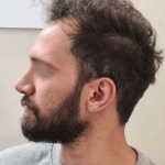 نمونه جراحی بینی دکتر مهدی قدیری (1)