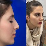 نمونه جراحی بینی دکتر نفیسه محمودی (2)