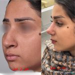 نمونه جراحی بینی دکتر نفیسه محمودی (5)
