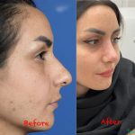 نمونه جراحی بینی دکتر نفیسه محمودی (6)