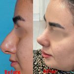 نمونه جراحی بینی دکتر نفیسه محمودی (8)