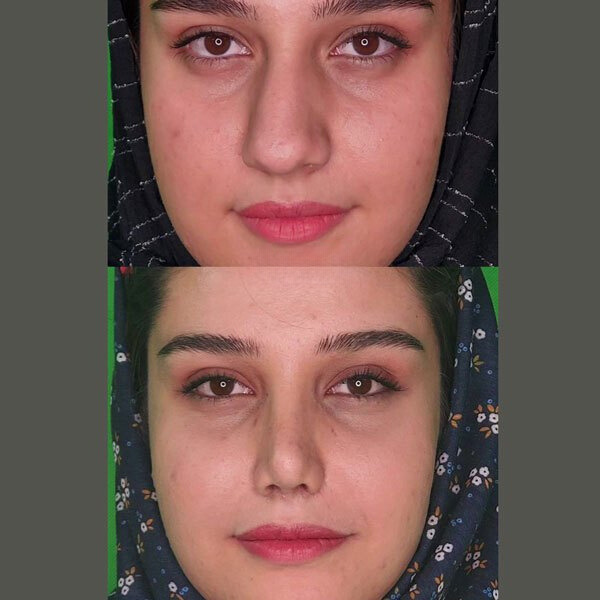 نمونه عمل بینی 1دکتر محسن فنی
