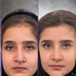 نمونه عمل بینی دکتر اصغر معمارزاده (2)