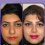 نمونه عمل بینی دکتر اصغر معمارزاده (3)