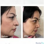 نمونه عمل بینی دکتر اصغر معمارزاده (4)