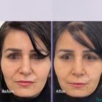 نمونه عمل بینی دکتر اصغر معمارزاده (6)