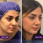 نمونه عمل بینی دکتر اصغر معمارزاده (7)