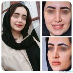 نمونه عمل بینی دکتر شهاب خسروی (4)