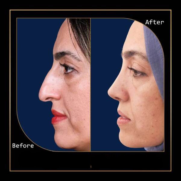 نمونه عمل بینی دکتر علی عقیلی 2