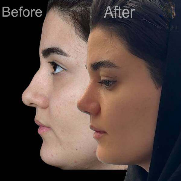 نمونه عمل بینی دکتر علی عقیلی