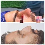 نمونه عمل بینی دکتر علیرضا خدامی (4)
