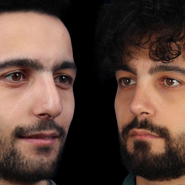 نمونه عمل بینی دکتر علیرضا مجلسی 2