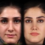 نمونه عمل بینی دکتر علیرضا مجلسی 3