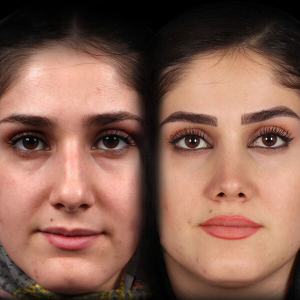 نمونه عمل بینی دکتر علیرضا مجلسی 3