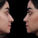نمونه عمل بینی دکتر علیرضا مجلسی 5