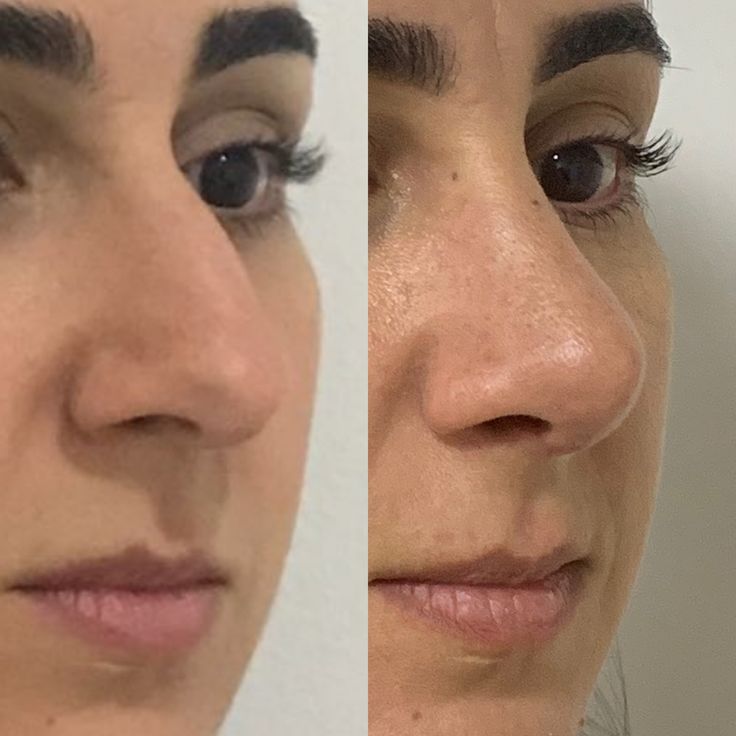 نمونه عمل بینی دکتر محسن فنی 3
