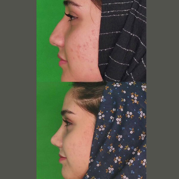 نمونه عمل بینی دکتر محسن فنی 5