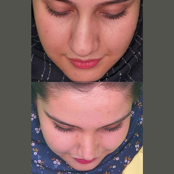 نمونه عمل بینی دکتر محسن فنی 6