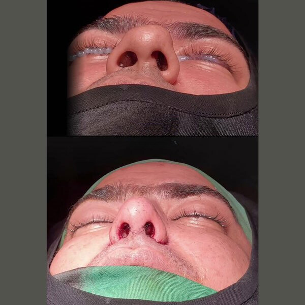 نمونه عمل بینی دکتر محسن فنی 7