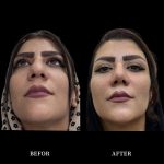 نمونه عمل بینی دکتر محمدحسین دادگرنیا