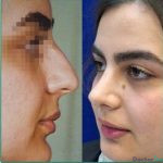 نمونه عمل بینی دکتر مهدی صفاری طاهری (1)