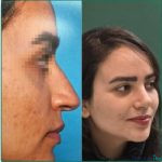 نمونه عمل بینی دکتر مهدی صفاری طاهری (4)