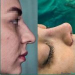 نمونه عمل بینی دکتر مهدی صفاری طاهری (5)