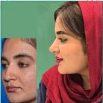 نمونه عمل بینی دکتر مهدی صفاری طاهری (7)