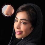 نمونه عمل بینی دکتر نجارزاده 2