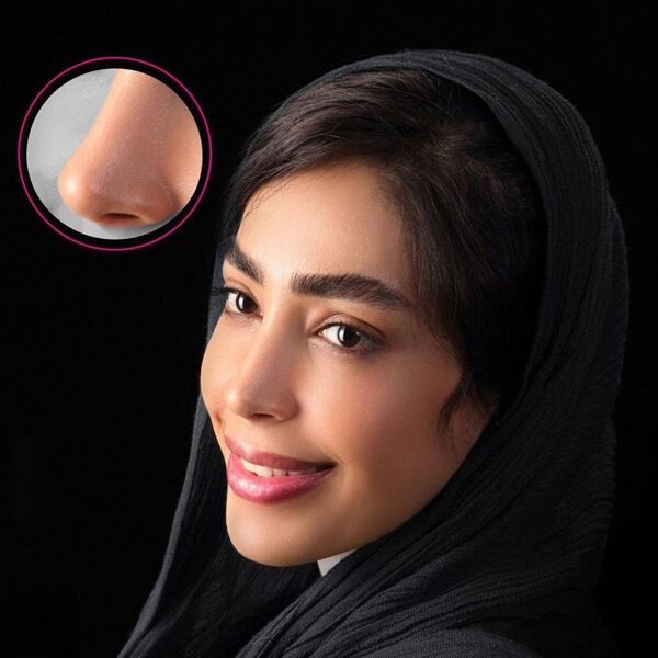 نمونه عمل بینی دکتر نجارزاده 2