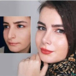 نمونه عمل بینی دکتر امیر نیازی 6