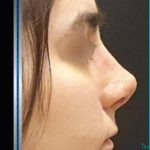 نمونه جراحی بینی دکتر جمشید سعید1