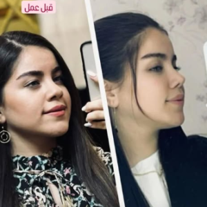 نمونه عمل بینی دکتر مهرداد نهائی (2)