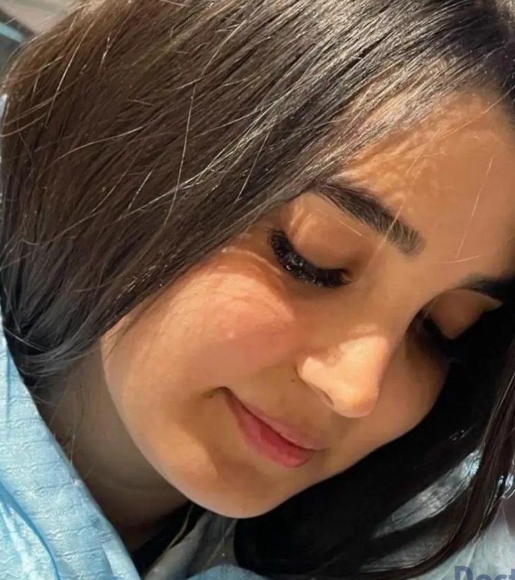 نمونه عمل بینی دکتر امید قاسم زاده 2