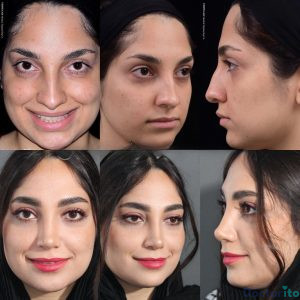 نمونه عمل بینی دکتر حسام جهاندیده 4