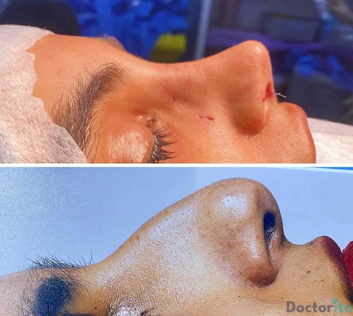 نمونه عمل بینی دکتر امید قاسم زاده 6