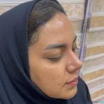 نمونه کار عمل بینی مژگان حسین رضایی2